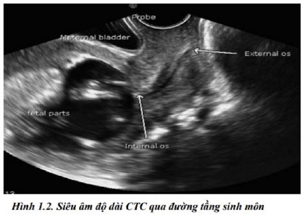 Nghiên cứu xây dựng quy trình sàng lọc thai phụ có cổ tử cung ngắn và điều trị dự phòng sinh non bằng Progesterone